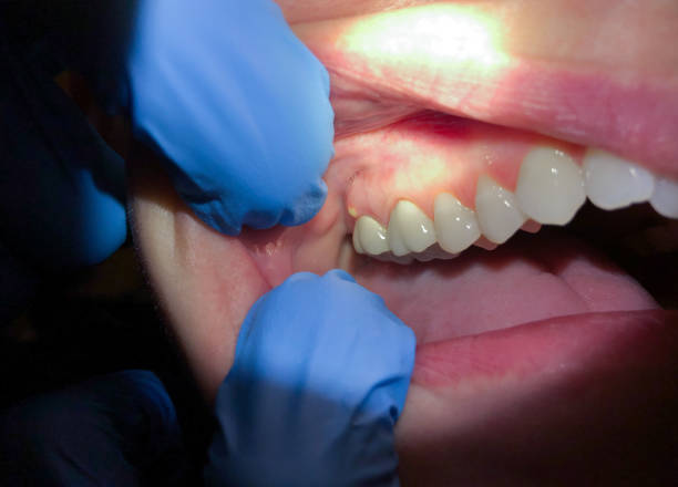 Best Emergency Dental Care for Broken or Chipped Teeth in Sutter, CA