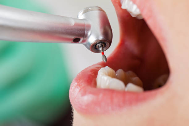 Best Emergency Dental Care for Broken or Chipped Teeth in Sutter, CA